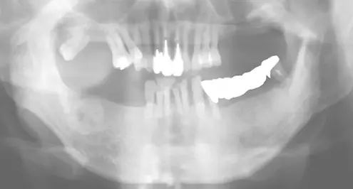 歯がグラグラで噛めない、見た目も綺麗にしたいの治療前の画像