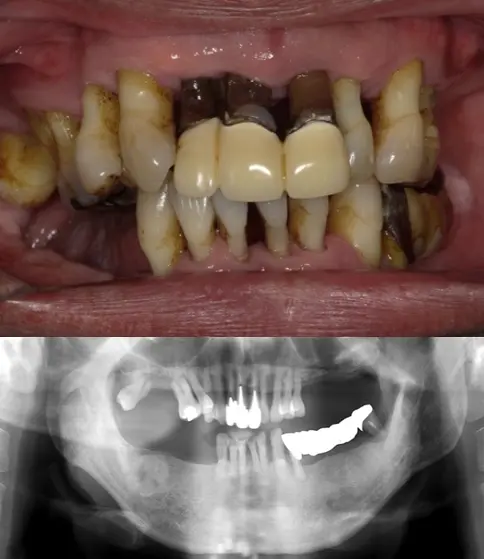 歯がグラグラで噛めない、見た目も綺麗にしたいの治療前の画像