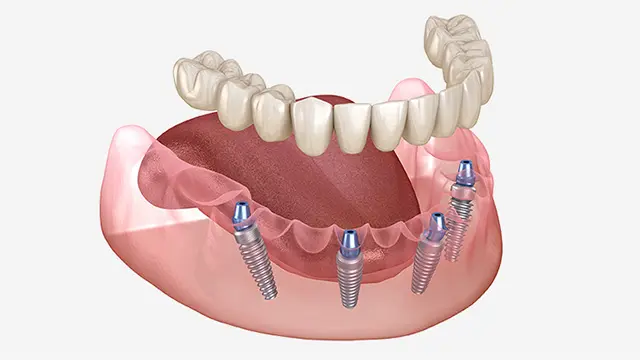 なぜオールオン4で顔が変わると言われるのか？そのメカニズムを解説の画像