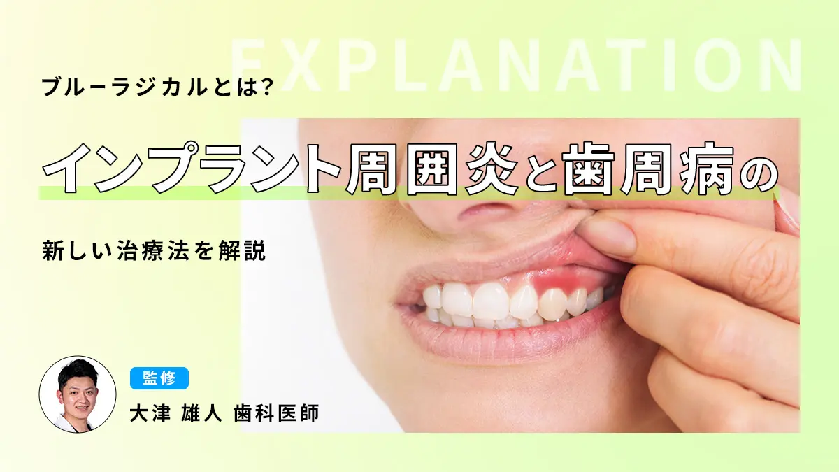 ブルーラジカルとは？インプラント周囲炎と歯周病の新しい治療法を解説の画像