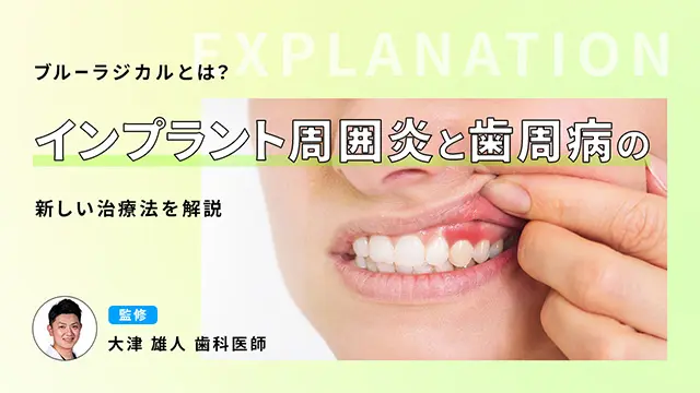 ブルーラジカルとは？インプラント周囲炎と歯周病の新しい治療法を解説の画像