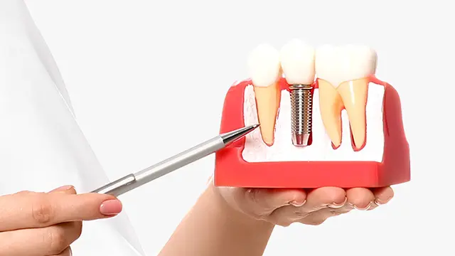 インプラントは高齢まで一生ものとして使える?の画像