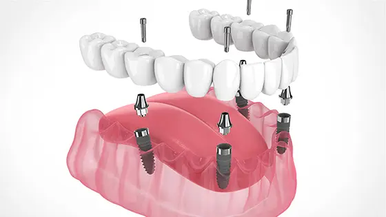 オールオン4ができるおすすめの歯医者の画像