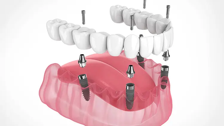 オールオン4とは？の画像