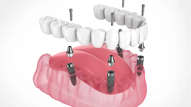 オールオン4とは？の画像