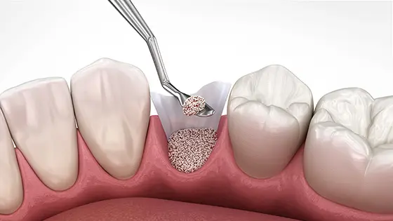 骨造成ができるおすすめの歯医者の画像