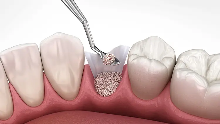 骨造成とは？の画像