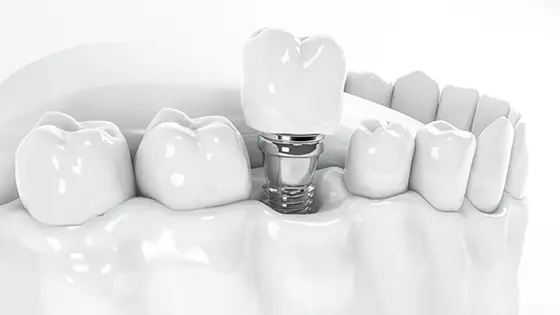 フラップレスインプラントができるおすすめの歯医者の画像