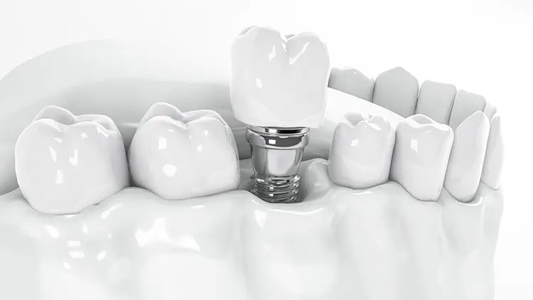 フラップレスインプラントとは?の画像