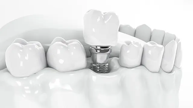 フラップレスインプラントとは？の画像