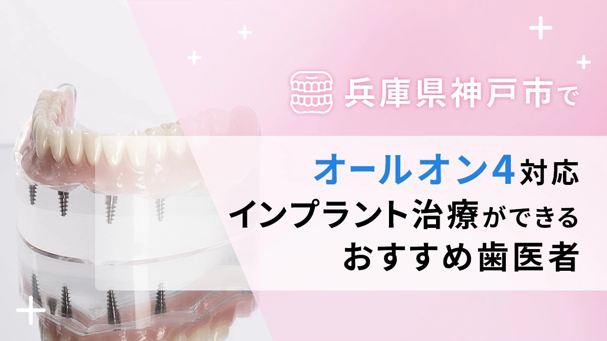 兵庫県神戸市でオールオン4対応のインプラント治療ができるおすすめ歯医者5選の画像