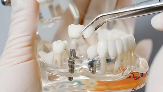 インプラント除去ができるおすすめの歯医者の画像