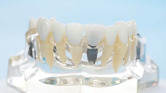 ワンデイインプラントができるおすすめの歯医者の画像