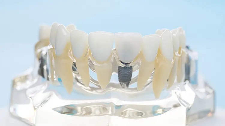 ワンデイインプラントとは？の画像