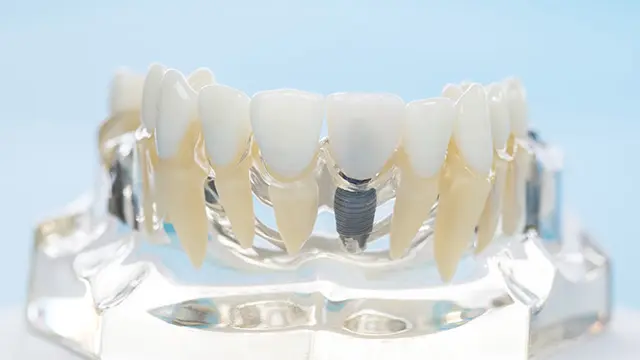 ワンデイインプラントとは？の画像