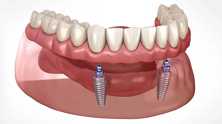 オーバーデンチャーとは？の画像