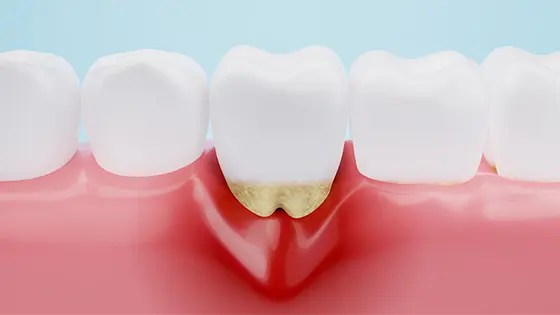 歯周病治療ができるおすすめの歯医者の画像