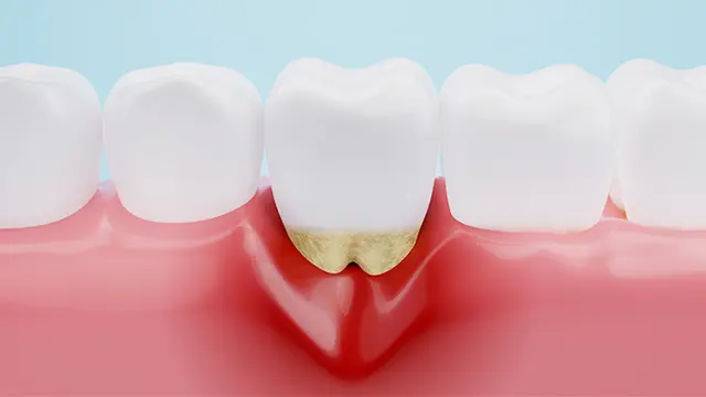 歯周病治療とは？の画像